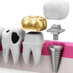 Restorative Dentistry