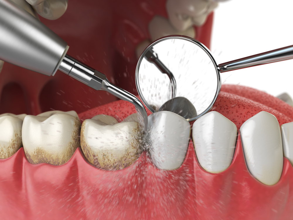 Best Tooth Cleaning Service in Banepa; Healthy and Hygienic