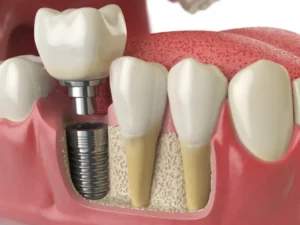 Get Dental Implant in Banepa; Perfect for Single or Multiple Missing Tooth
