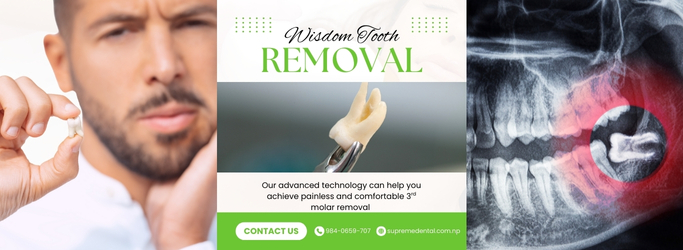 Wisdom Tooth Removal