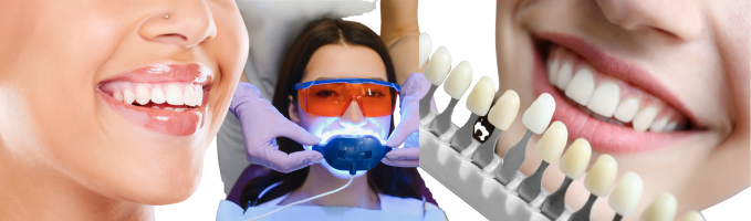Teeth Whitening