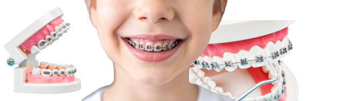 Braces Treatment in Banepa