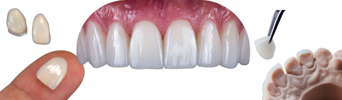 Dental Veneers