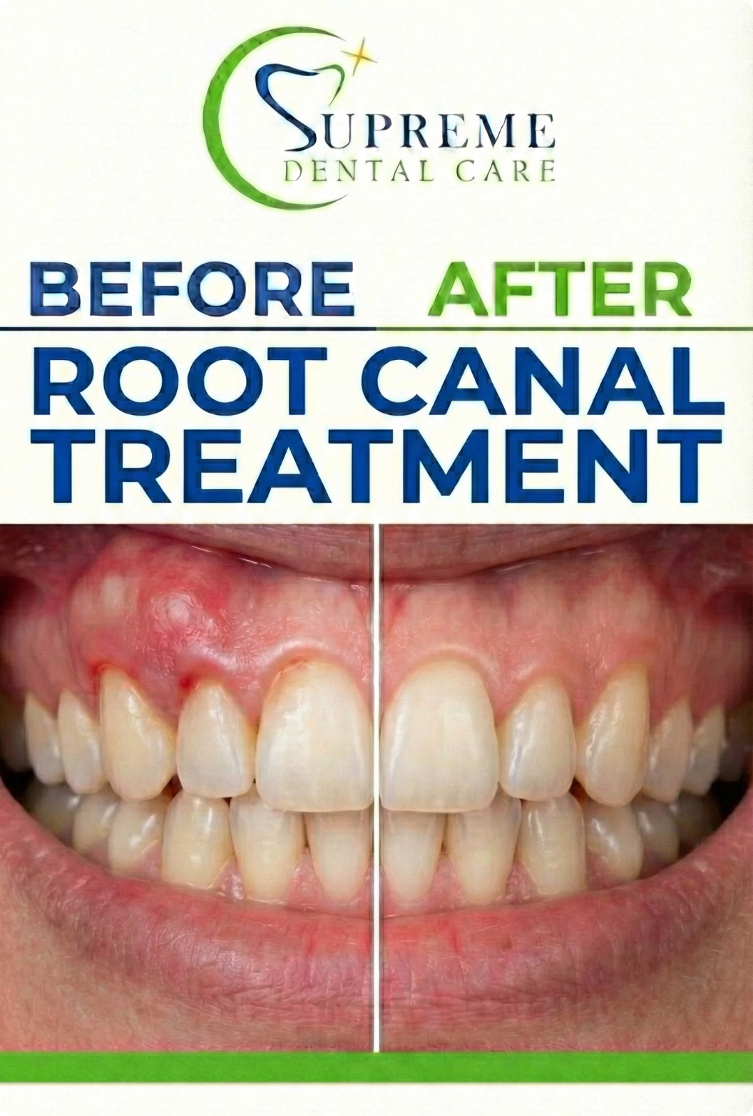 Before After Root Canal Treatment in Banepa