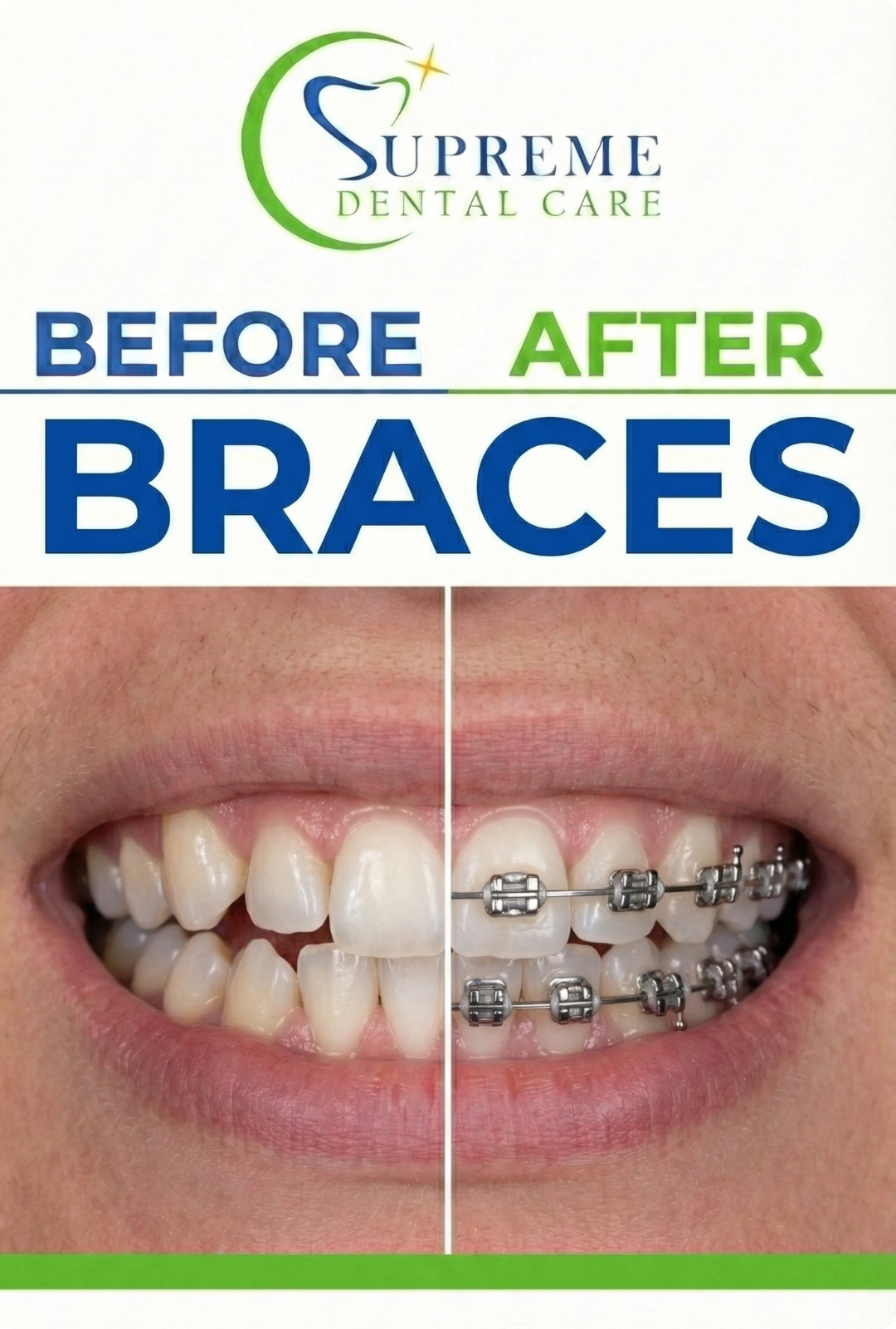 Before After Braces Treatment in Banepa