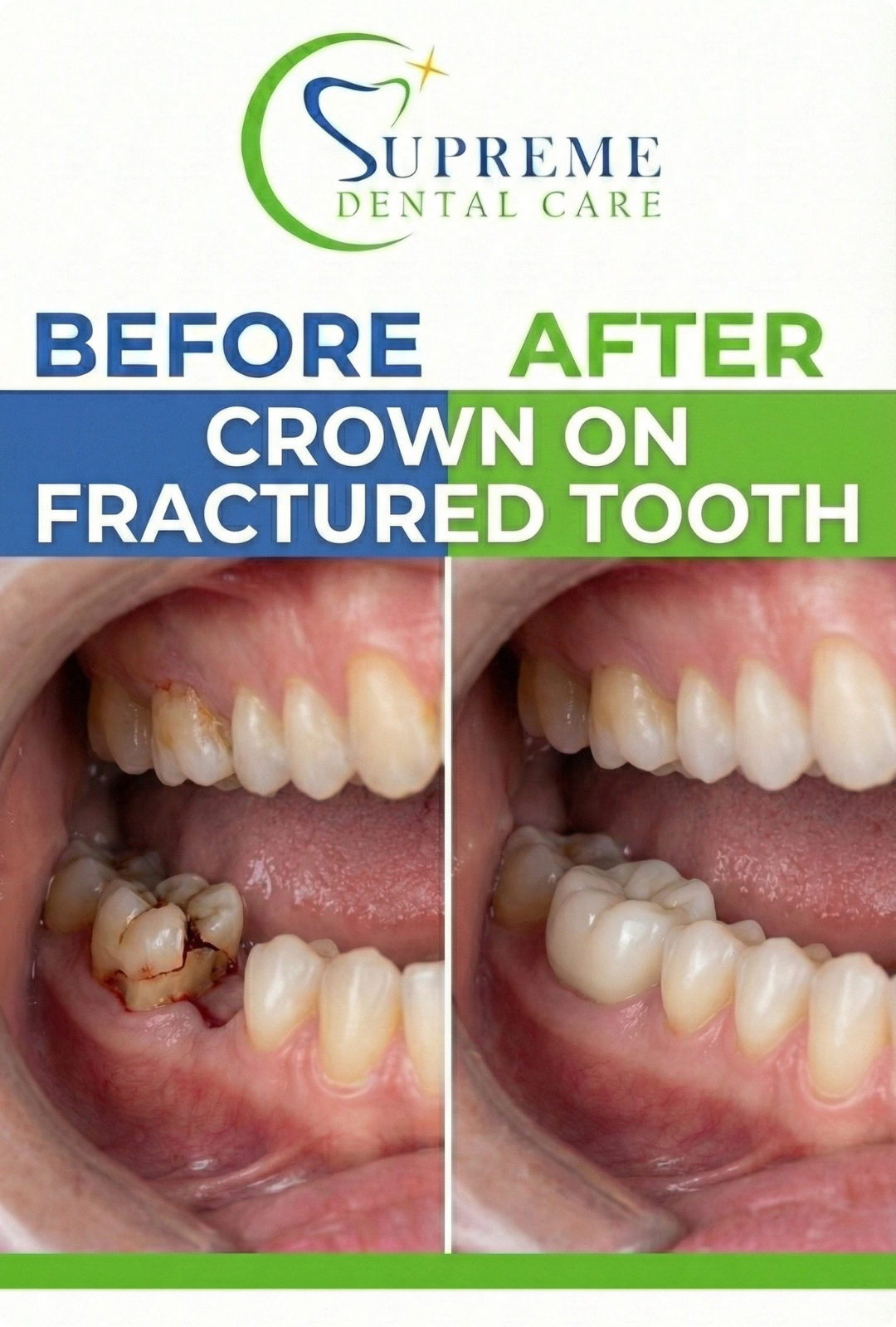 Before After Dental Crown in Banepa