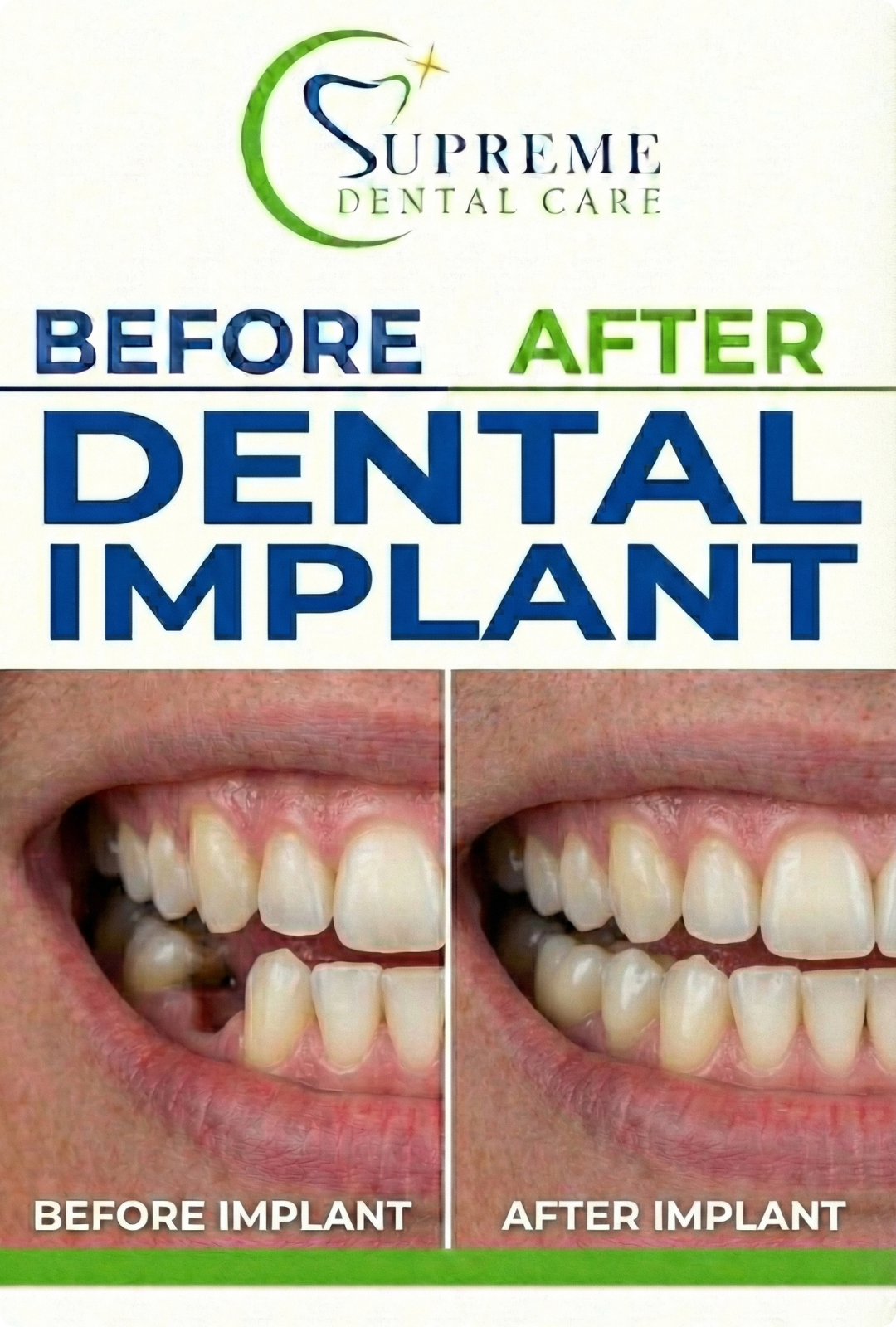 Before After Dental Implant in Banepa