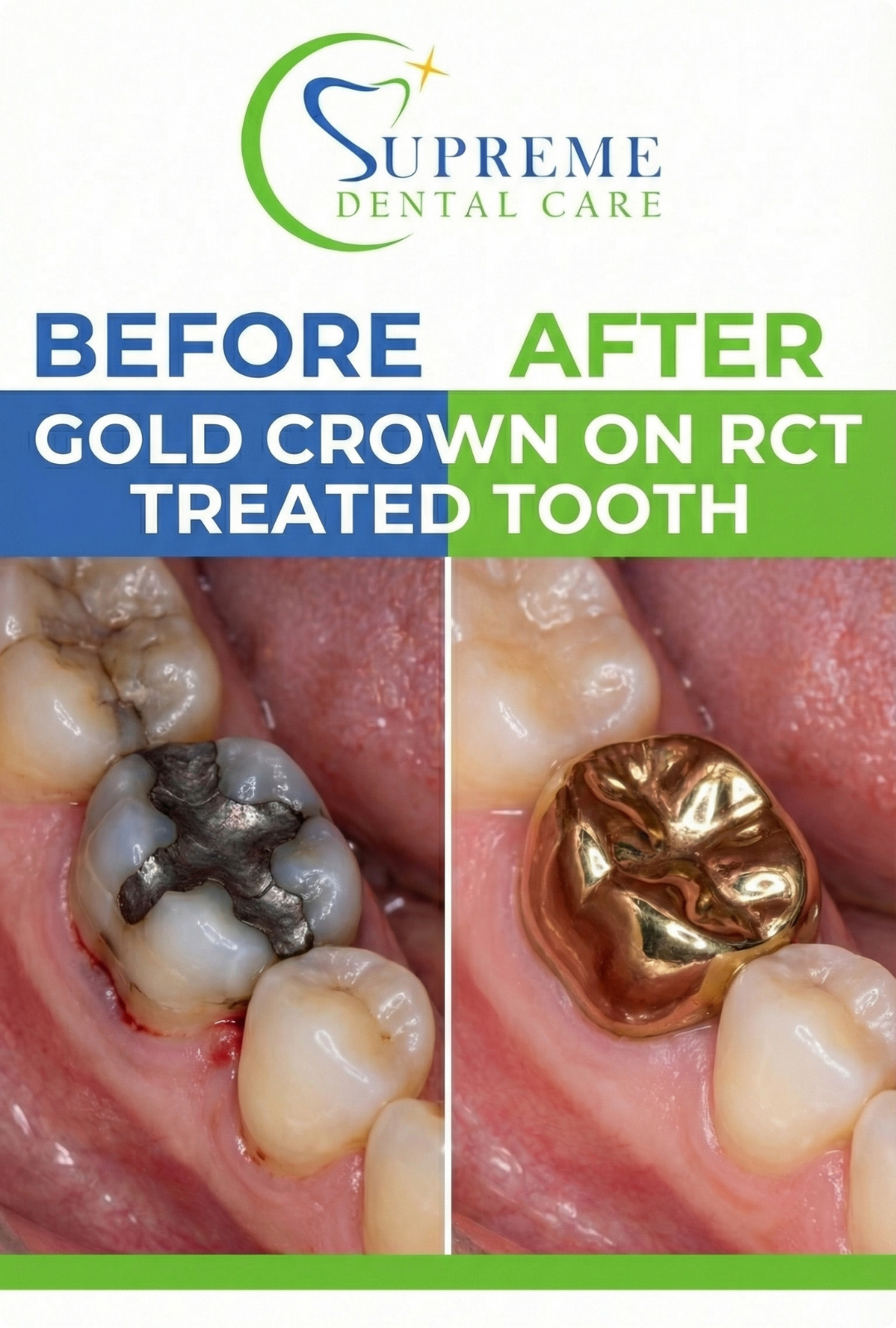 Before After Gold Crown in Banepa