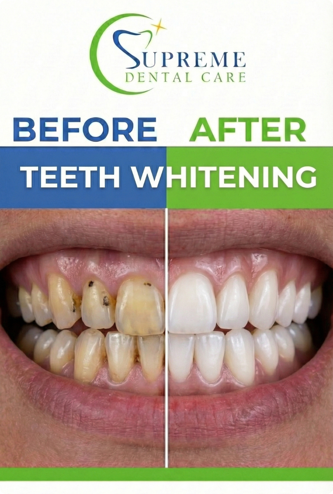 Before After Teeth Whitening in Banepa