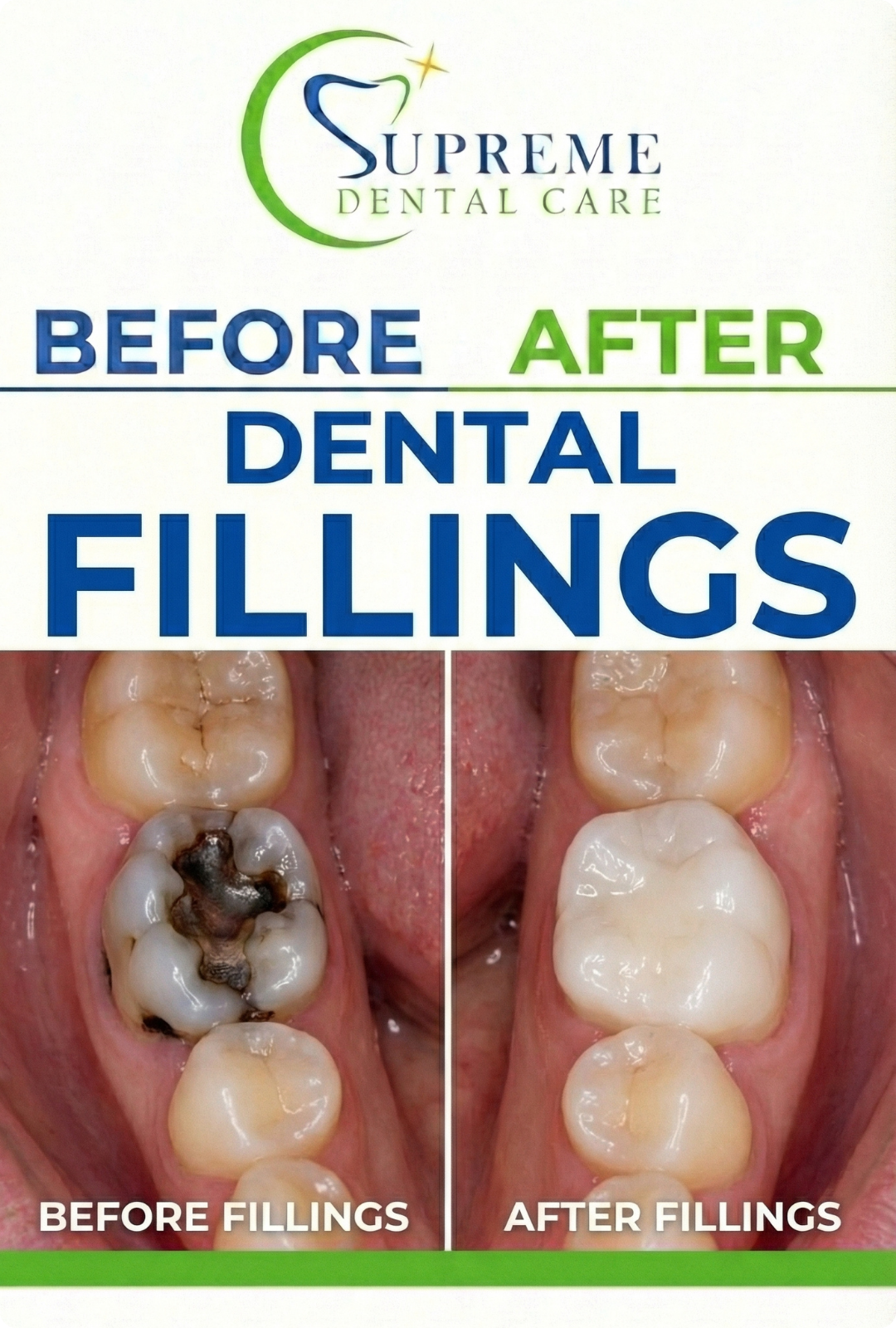 Before After Tooth Restoration in Banepa