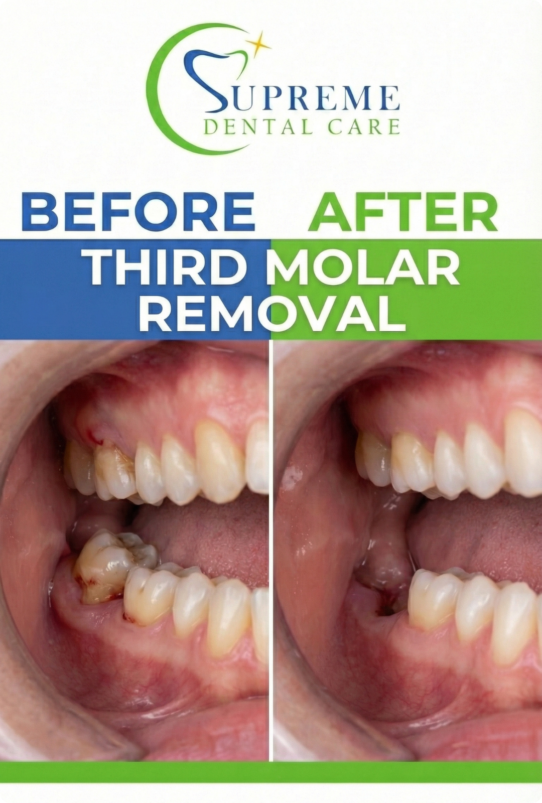 Before After Wisdom Tooth Extraction in Banepa